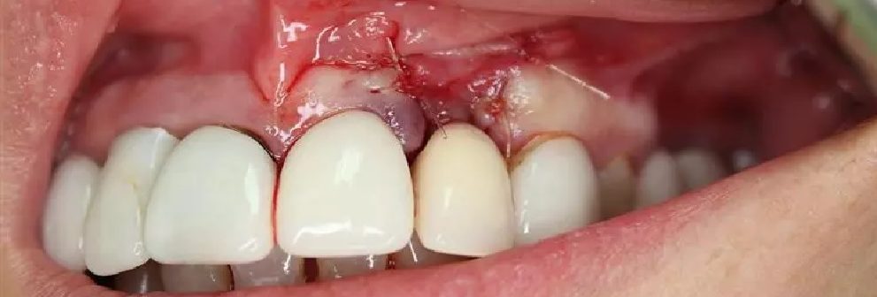 periodoncia